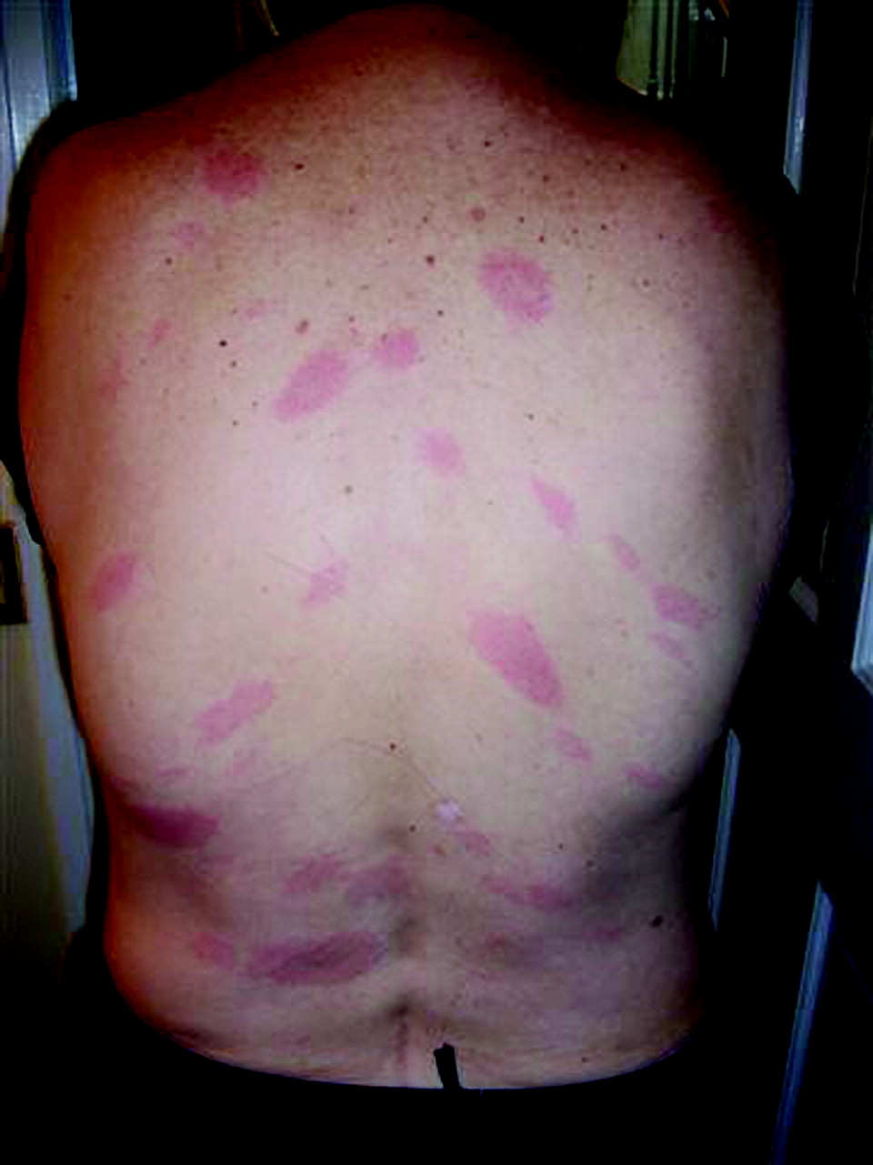 a) Day 1, patient presents with flat erythematous rash with scattered