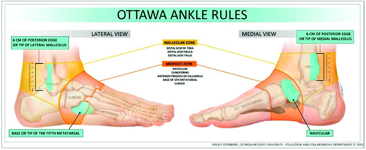 Split Peroneus Brevis Tendon: An Unusual Cause of Ankle Pain and