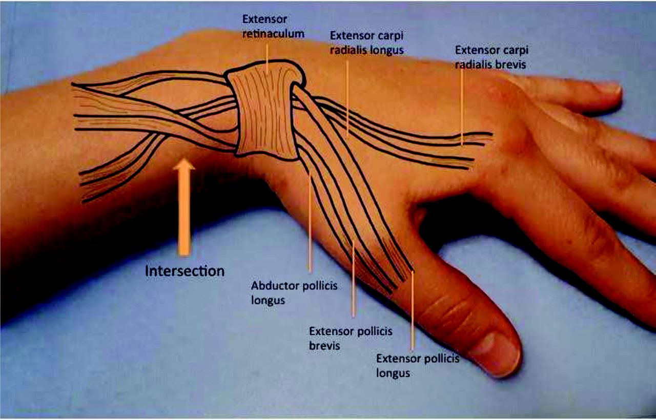 intersection syndrome symptoms